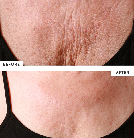 SILC Skin Decollette Pad